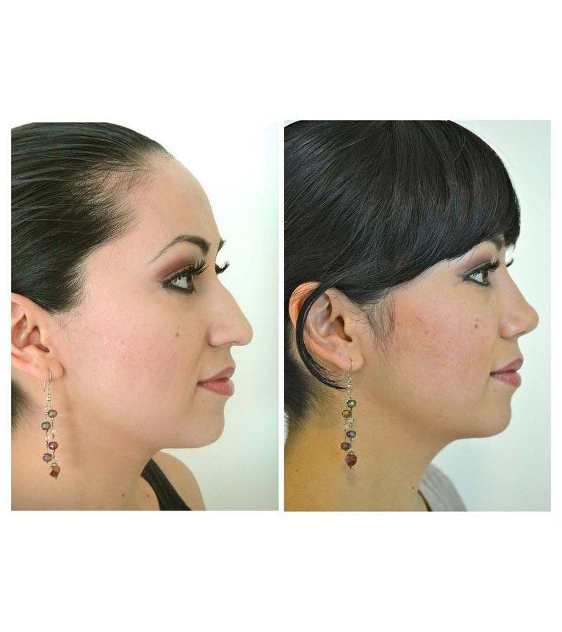 rinoplastia guadalajara
