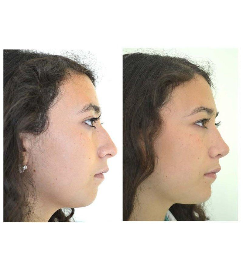 rinoplastia guadalajara