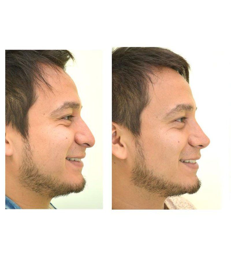 rinoplastia guadalajara