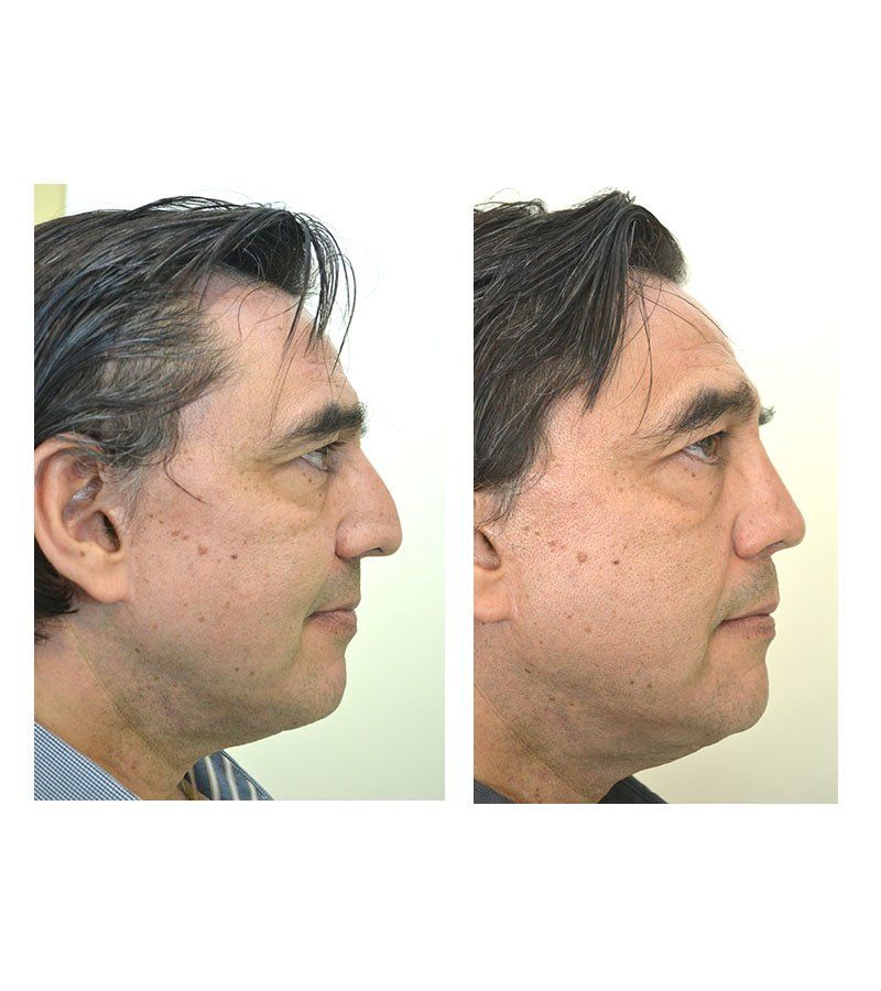 Cirugia de nariz antes y despues