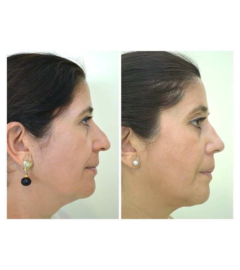 Cirugia de nariz antes y despues