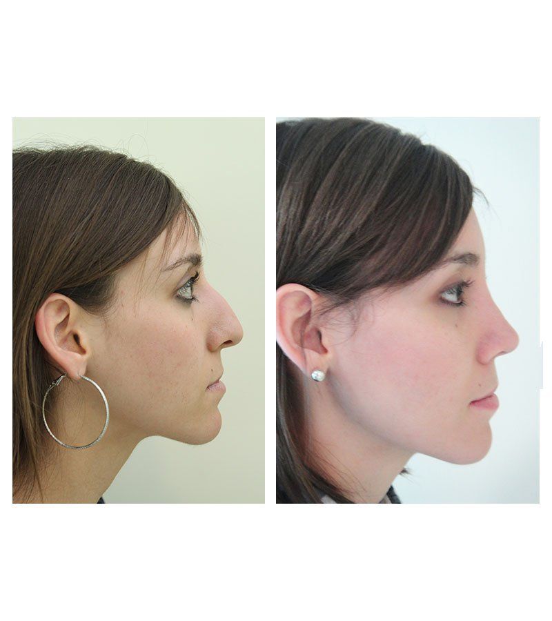 Cirugia de nariz antes y despues