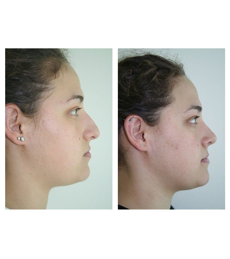 Cirugia de nariz antes y despues