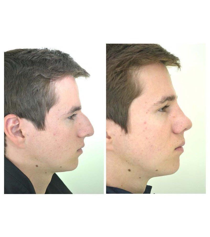 rinoplastia guadalajara
