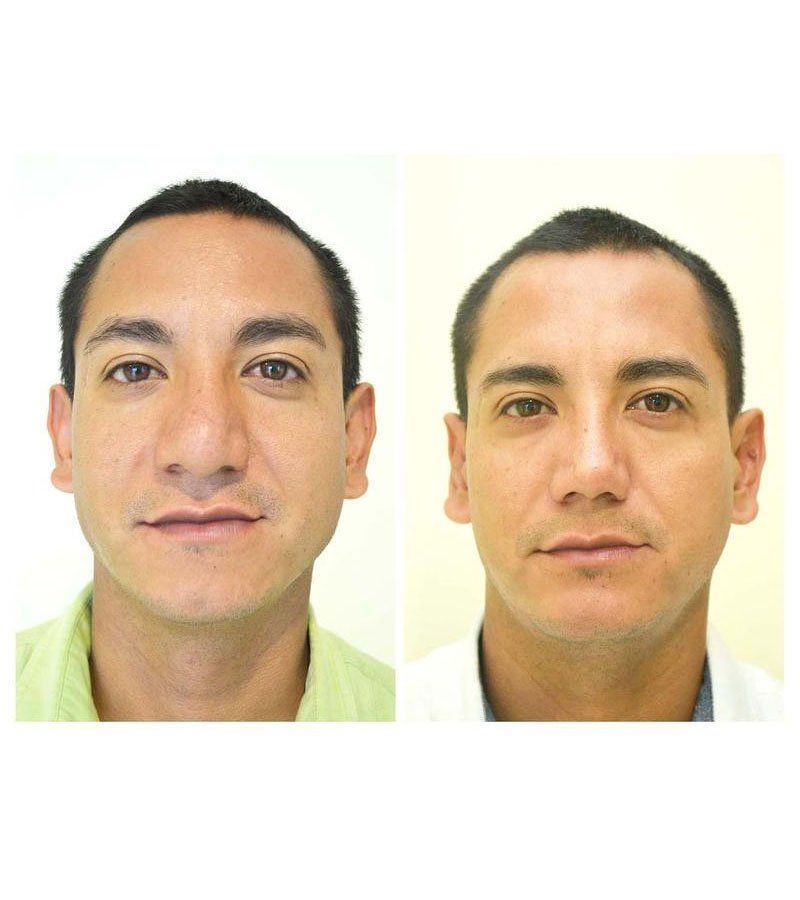 rinoplastia guadalajara