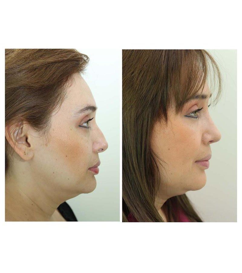 rinoplastia guadalajara