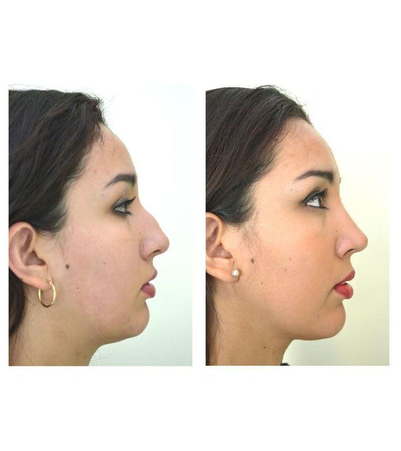 rinoplastia guadalajara