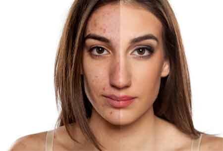 Acne before and after — Dermatology Clinic in Kenner, LA