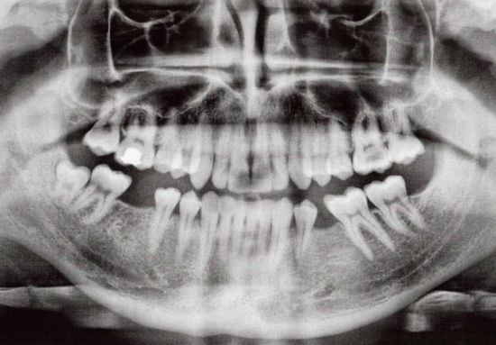 radiografia dentale
