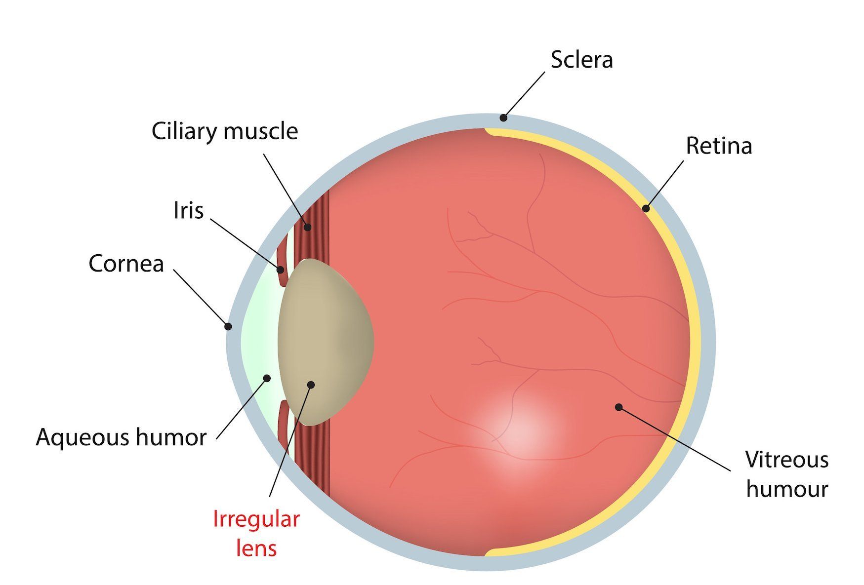Astigmatism