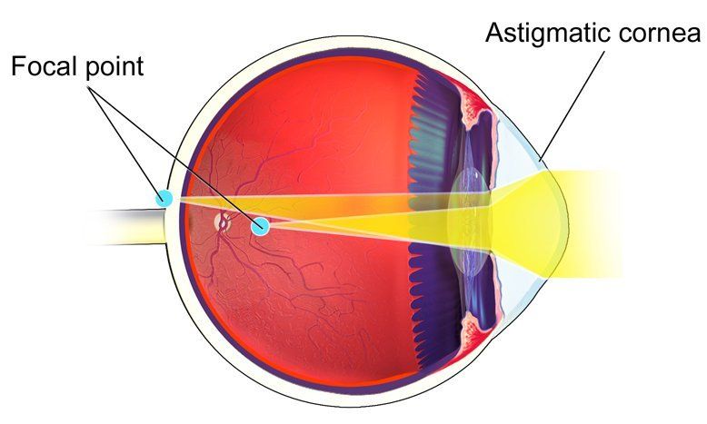 Astigmatism - Astigmatic Cornea