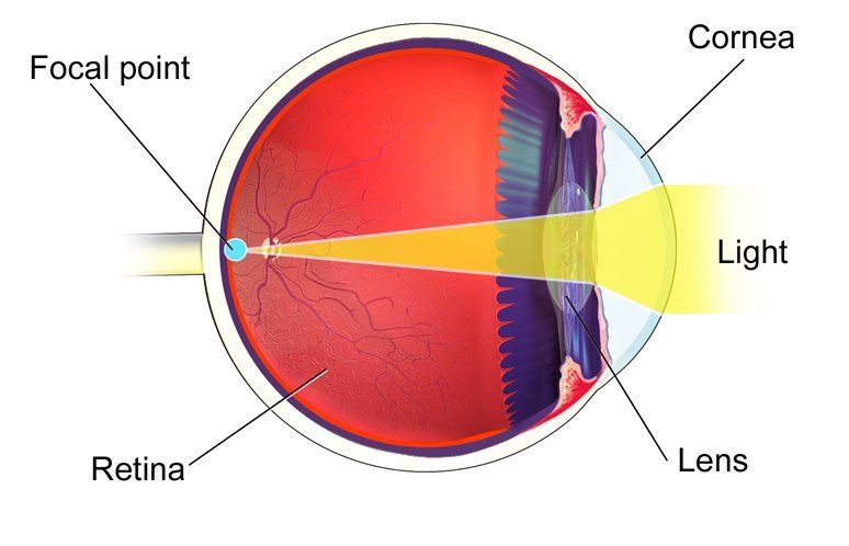 Astigmatism - Normal Cornea