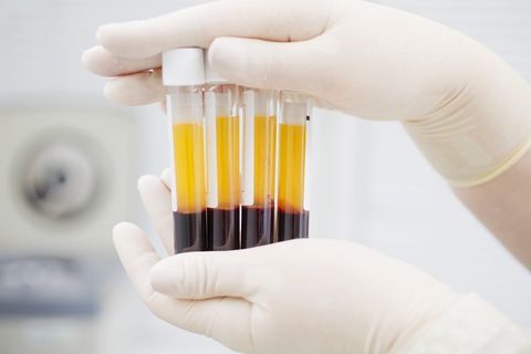Tubos com sangue para se fazer PRP