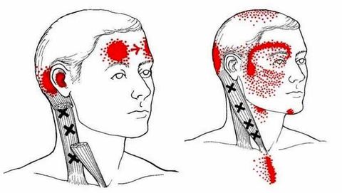 Foto ilustrativa de trigger points na zona da cabeça
