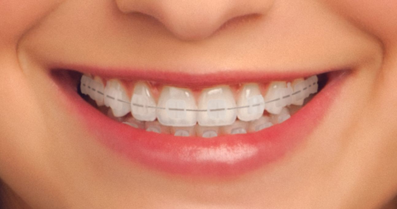 Braces