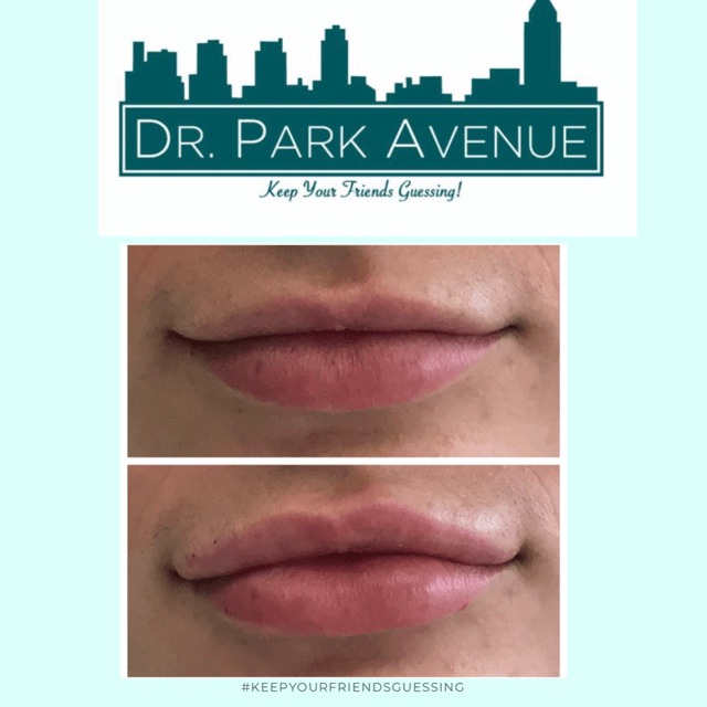 Before and after lips, part of an advertisement for cosmetic procedures.