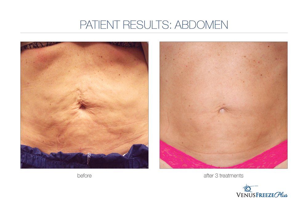 Abdomen before/after 3 treatments: Skin with wrinkles before, smoother after, visible navel.