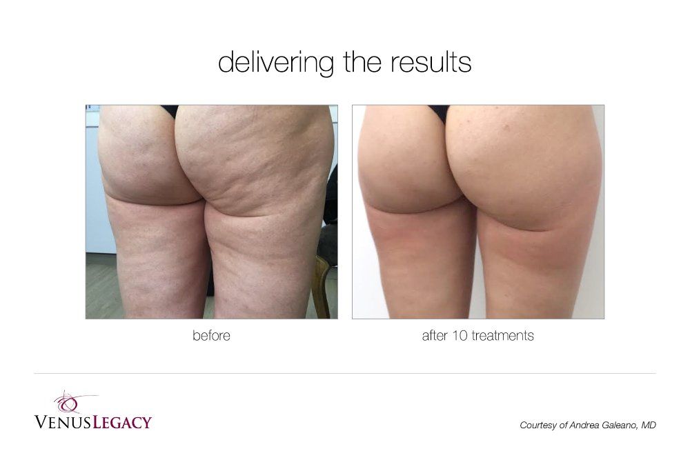 Before-and-after of a buttocks with cellulite. Right side shows smoother skin after 10 treatments.