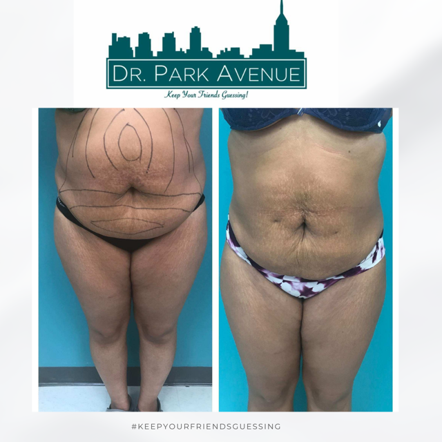 Before and after photos of a person's abdomen, waist, and thighs. The 
