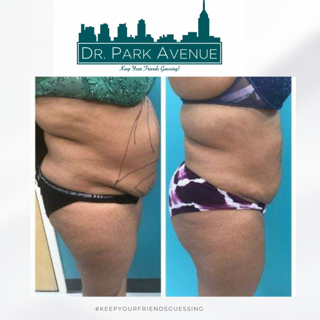 Before and after view of a person's torso, showing cosmetic surgery results.
