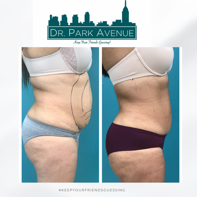 Before and after profile views of a torso after a cosmetic procedure, with pre-op markings.