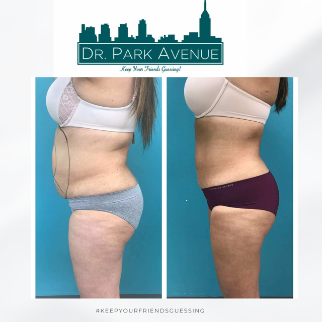 Side-by-side view: Before and after body contouring. The after shows a slimmer waist and improved shape.