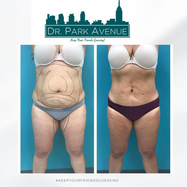 Before and after of a person's abdomen and thighs; post-surgery view shows reduced fat and skin.