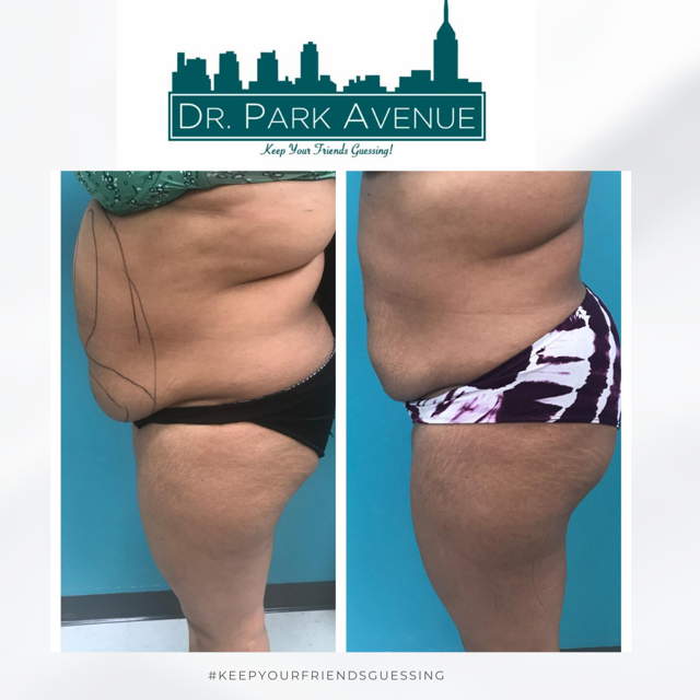 Side-by-side view showing a person's abdomen and thigh before and after a body contouring procedure.