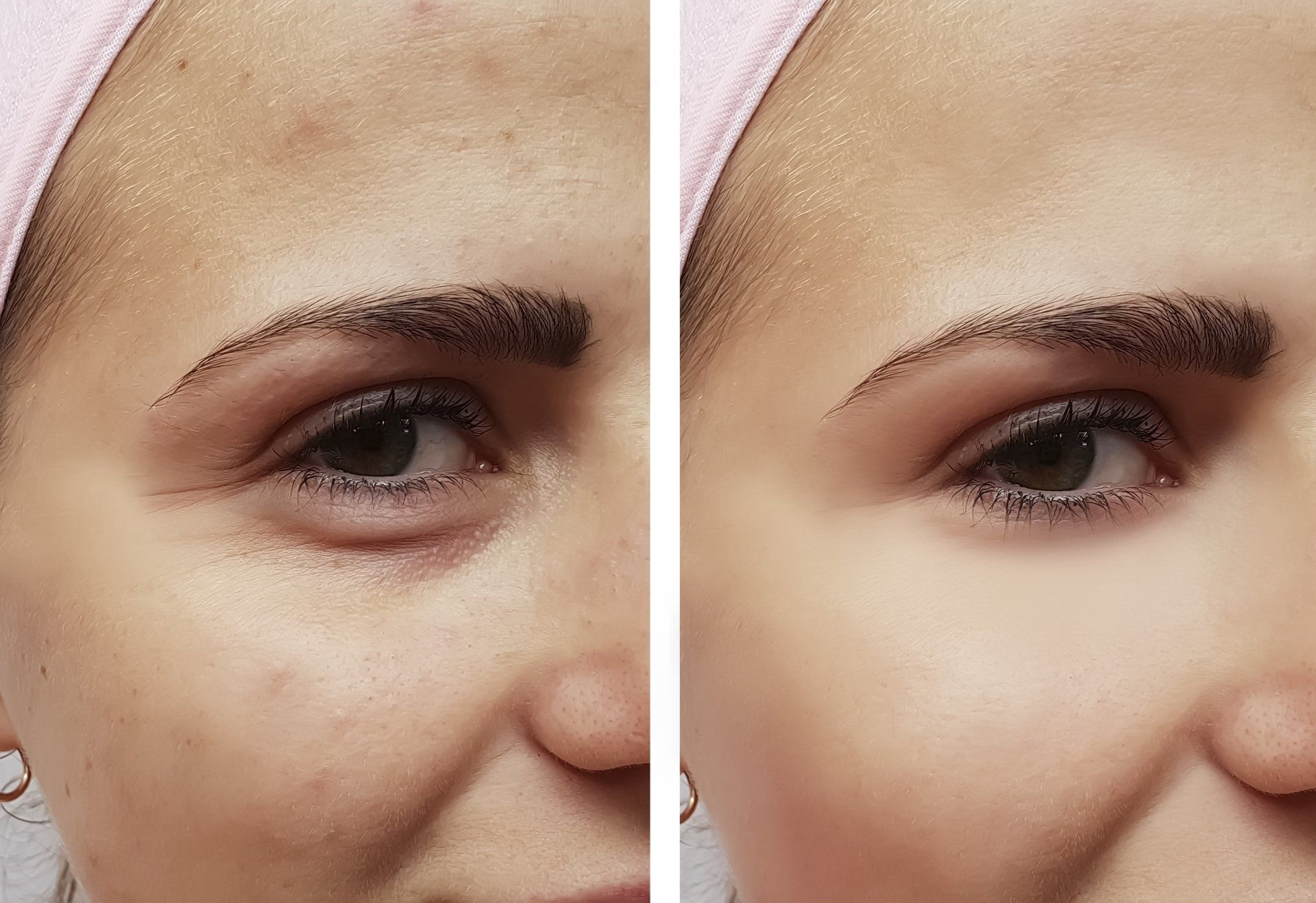 Before and After Wrinkle Reduction Treatment — Brick, NJ — Dr.Park Ave Before and After Wrinkle Reduction Treatment — Brick, NJ — Dr.Park Ave