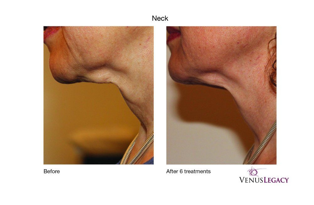 Side-by-side view of a neck before and after treatments, showing reduced wrinkles and tighter skin.