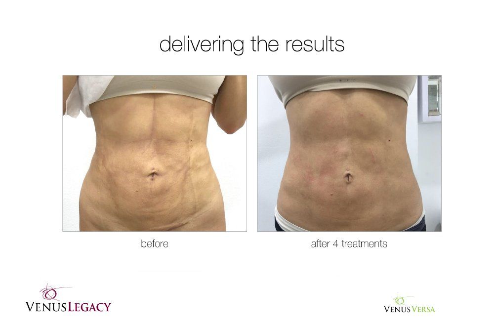 Before and after photos of a person's abdomen, showing skin tightening after 4 treatments.