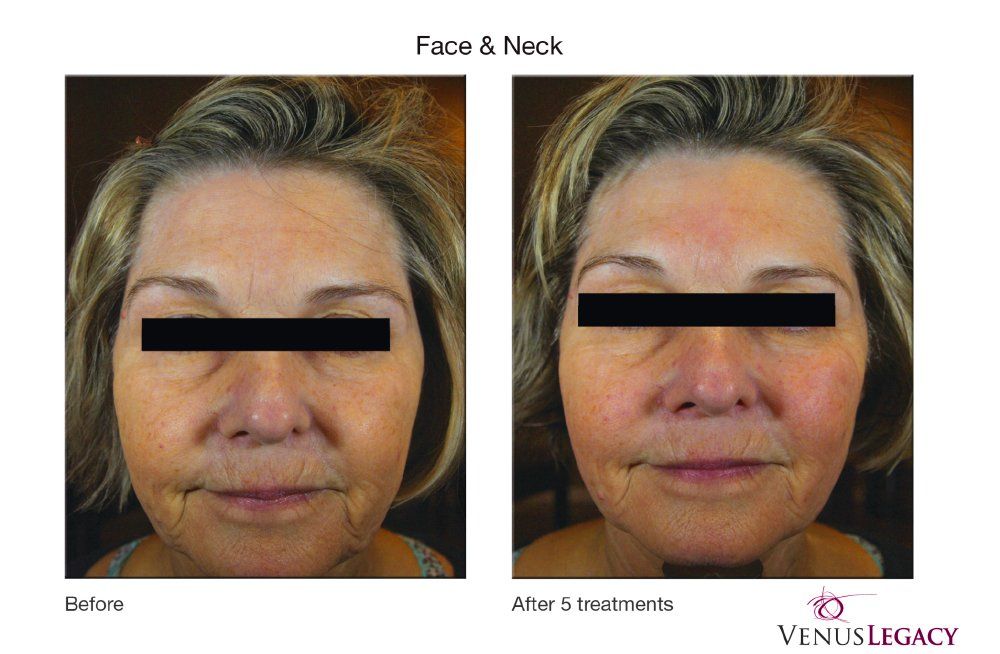 Before and after facial treatments showing wrinkle reduction on a woman's face and neck.