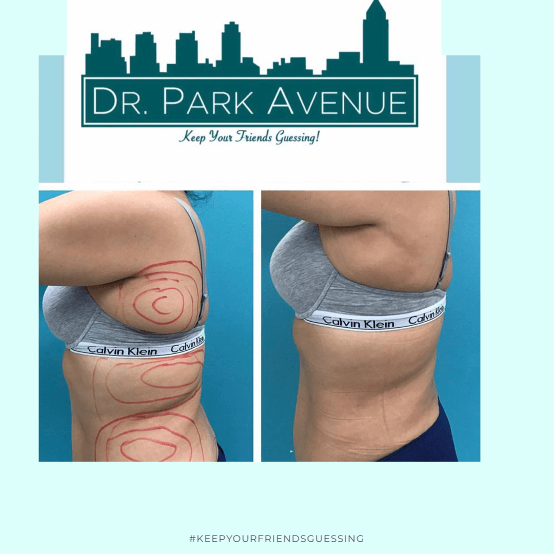 Before and after photos of a person's side, possibly after a body contouring procedure. Red markings visible.