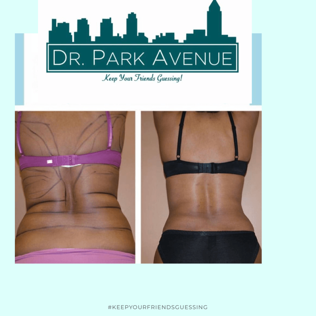 Before and after back liposuction. Skin is marked with lines.
