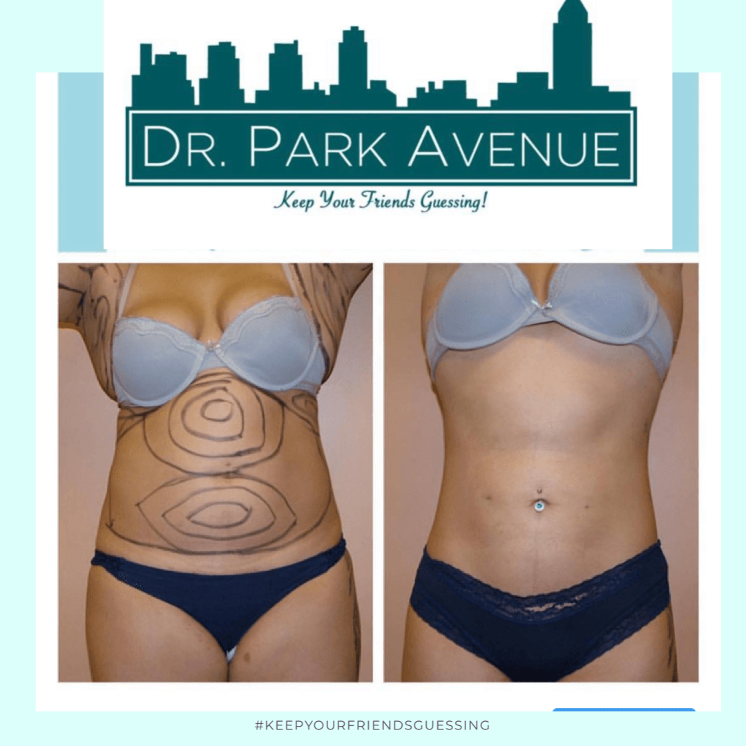 Before and after abdominal surgery. Gray bra, blue underwear. Surgical markings on abdomen.