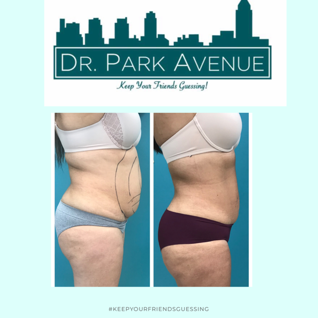 Before and after photos of a person's torso, demonstrating body contouring. The after photo shows a flatter abdomen.