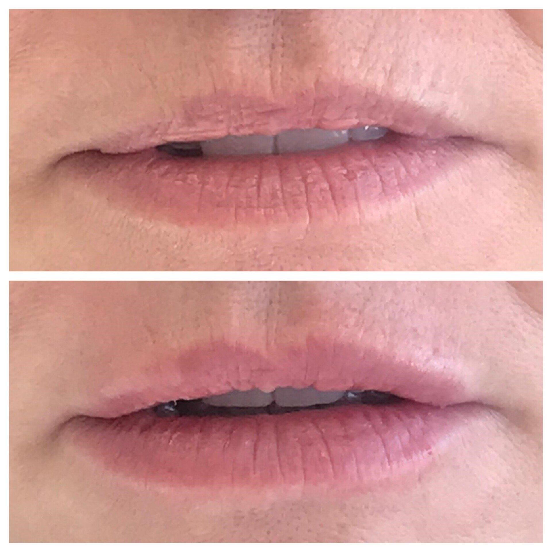 Two sets of lips before and after a lip treatment; lips appear fuller and more defined in the after photo.