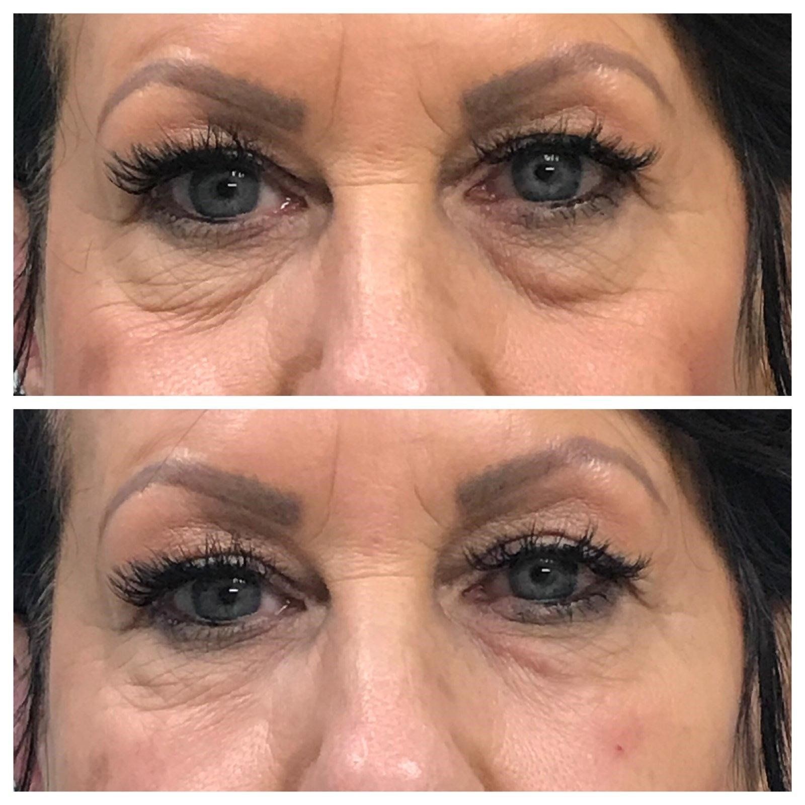 Side-by-side comparison of eyes: before and after. Showing reduction in under-eye wrinkles.