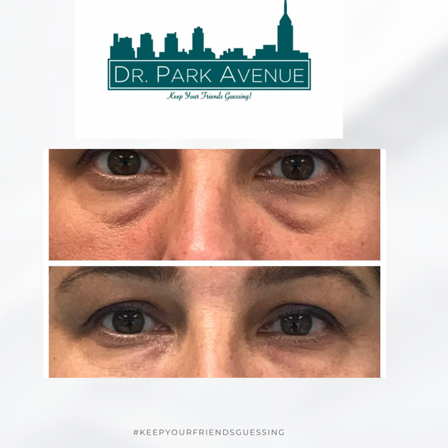 Before and after photos showing under-eye bag reduction at Dr. Park Avenue.