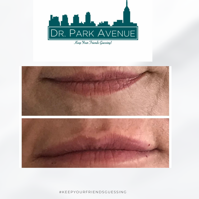 Before and after photos of lips; top lip is thinner than bottom lip.  