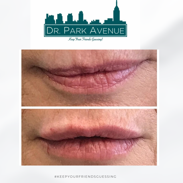 Before and after photos of lip augmentation, showing fuller lips.
