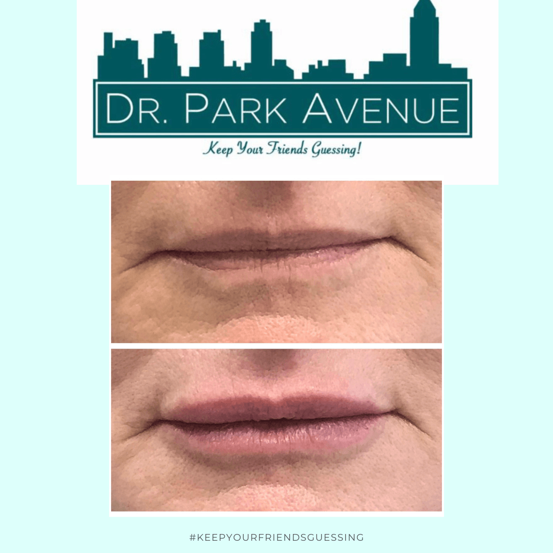 Before and after lip filler treatment: top, thin lips; bottom, fuller lips. Dr. Park Avenue logo at top.