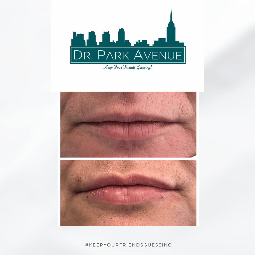 Before and after lips, showing lip augmentation results, with a skyline logo above.