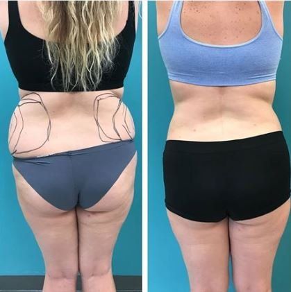 Before and after view of a person's lower back and hips after a cosmetic procedure; black swimwear.
