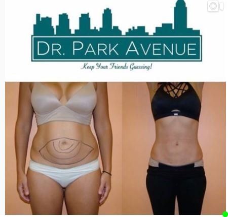 Before and after abdominal surgery. A person in underwear has lines drawn on their stomach, then stands after the procedure.