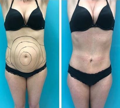Before and after abdominal procedure; woman in black lingerie, marked abdomen before, smooth after.