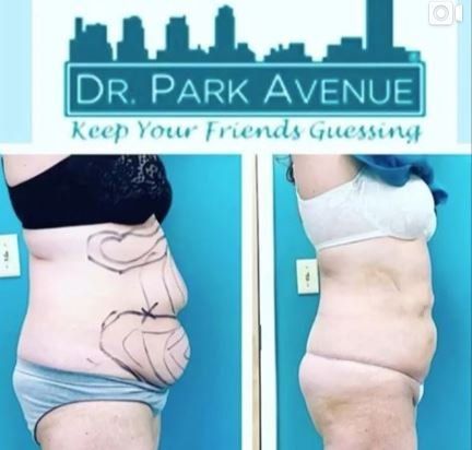 Before and after view of a person's torso, showing marked skin pre-surgery, then post-surgery with decreased fat.
