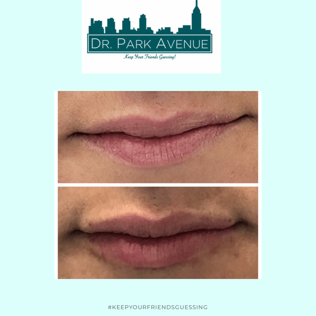 Lip filler before-and-after; top lips are thinner than bottom lips, which are fuller in the after photo.