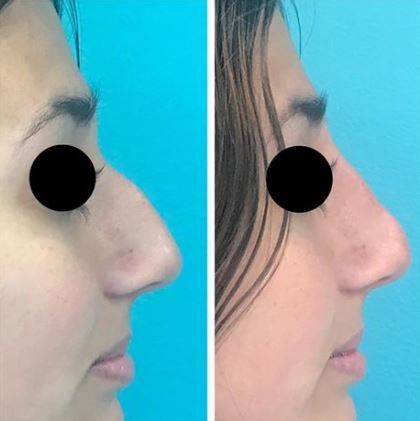 Before and after profile views of a nose reshaping; nose is smaller and straighter after the procedure.