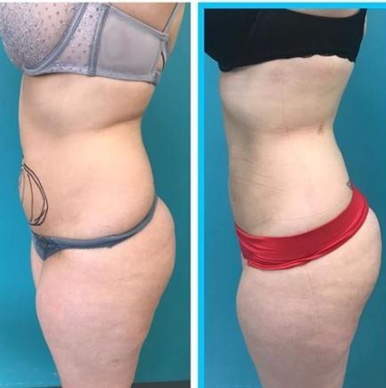 Side-by-side view, showing body transformation. Before photo shows stomach bulge. After photo has more defined curves.